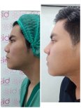 نتائج تجميل الأنف العرقي قبل وبعد في ID Clinic Bangkok، تحسين شكل الأنف الجانبي