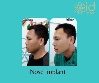 نتائج قبل وبعد زراعة الأنف بعملية تجميل عرقية في ID Clinic Bangkok