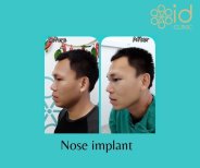 نتائج قبل وبعد زراعة الأنف بعملية تجميل عرقية في ID Clinic Bangkok