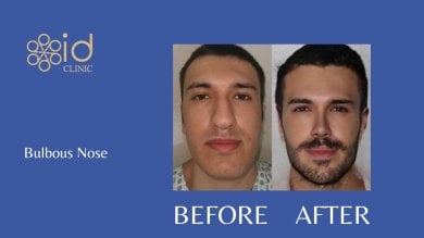 قبل وبعد تجميل الأنف العرقي للأنف المنتفخ في ID Clinic Bangkok، تحسين واضح للأنف