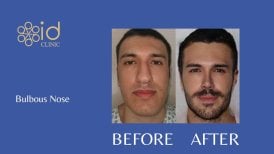 قبل وبعد تجميل الأنف العرقي للأنف المنتفخ في ID Clinic Bangkok، تحسين واضح للأنف