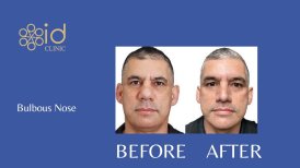 قبل وبعد تجميل الأنف العرقي للأنف المنتفخ في ID Clinic Bangkok، نتيجة واضحة