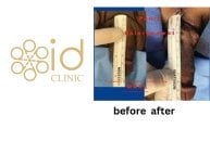 نتائج تكبير القضيب قبل وبعد في ID Clinic Bangkok، زيادة واضحة في الطول
