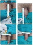نتائج قبل وبعد جراحة تكبير القضيب في ID Clinic Bangkok، زيادة واضحة في الطول