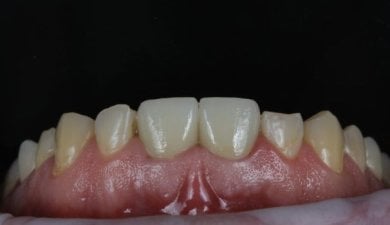 before-after photo kostnaa-plastika