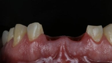 before-after photo kostnaa-plastika