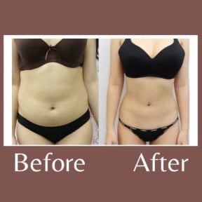 before-after photo 360-liposuction