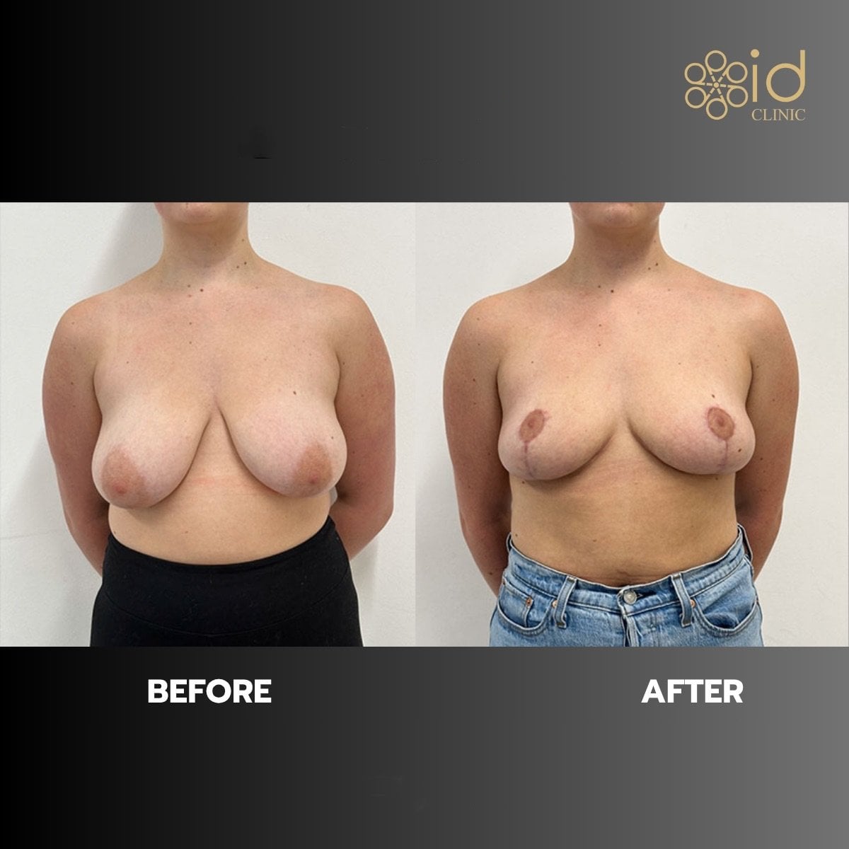 نتائج تكبير ورفع الثدي في ID Clinic Bangkok، تحسين شكل الثدي