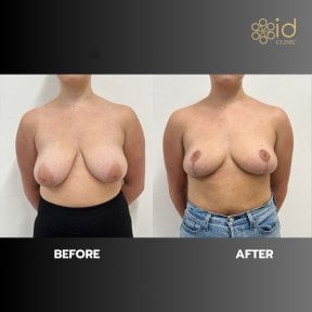 before-after photo breast-implants-with-breast-lift