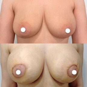 before-after photo breast-implants-with-breast-lift