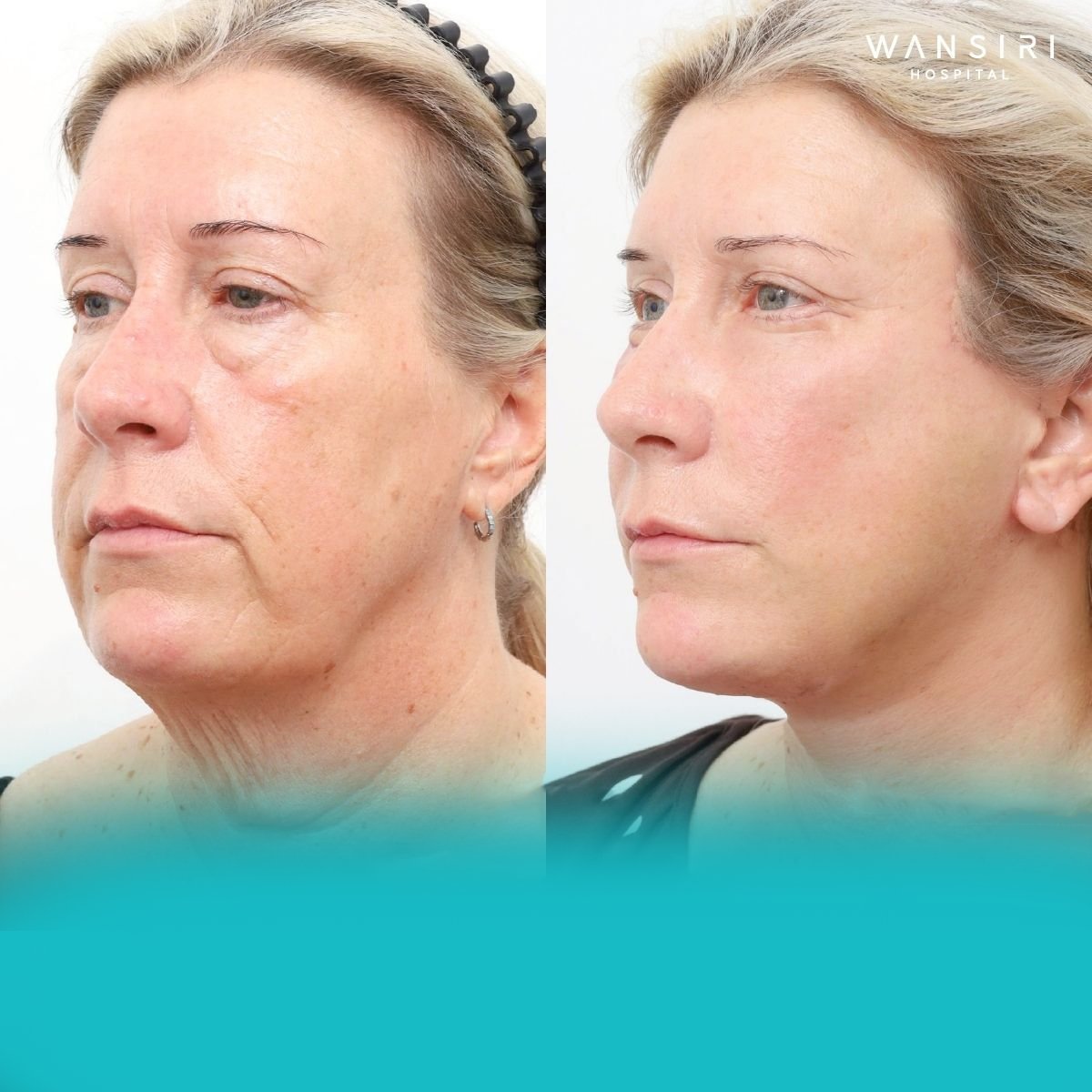 Antes y después de inyecciones de relleno en Wansiri Hospital, resultado rejuvenecedor