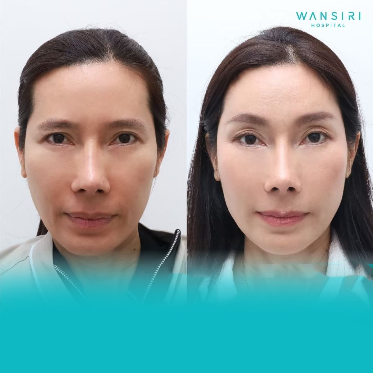 Resultados antes y después de rellenos faciales en Wansiri Hospital, mejora de volumen