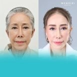 Antes y después de inyecciones de relleno en Wansiri Hospital: rejuvenecimiento facial visible