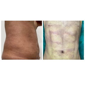 before-after photo liposuction