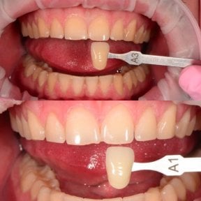 before-after photo otbelivanie-zubov