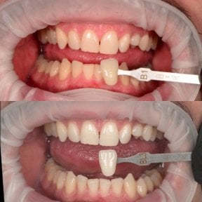 before-after photo otbelivanie-zubov