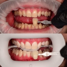 before-after photo otbelivanie-zubov