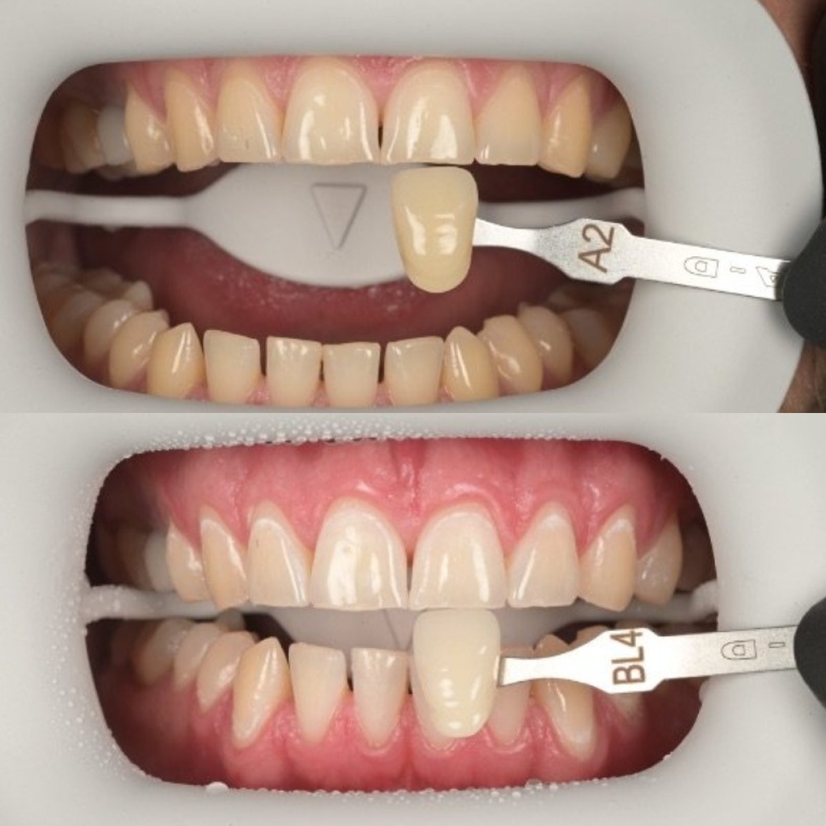 نتائج تبييض الأسنان قبل وبعد في RIKOTA Dental Clinic – ابتسامة أكثر بياضًا بوضوح