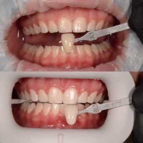 before-after photo otbelivanie-zubov