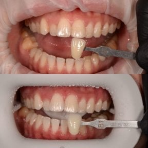before-after photo otbelivanie-zubov