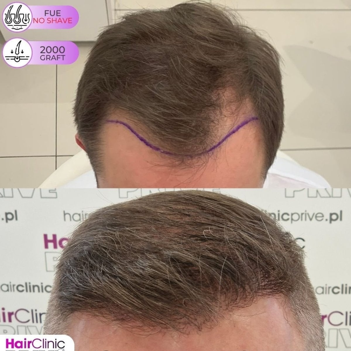 Resultado antes y después de trasplante capilar FUE sin rasurar, 2000 injertos en Hair Clinic PRIVÉ