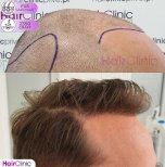 FUE hair transplant before and after at Hair Clinic PRIVÉ, 2350 grafts, natural hairline result