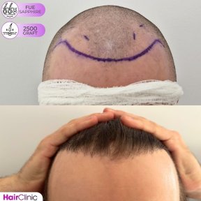 Before and after FUE hair transplant at Hair Clinic PRIVÉ, 2500 grafts for fuller hairline result