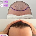 Before and after FUE hair transplant at Hair Clinic PRIVÉ, 2500 grafts for fuller hairline result