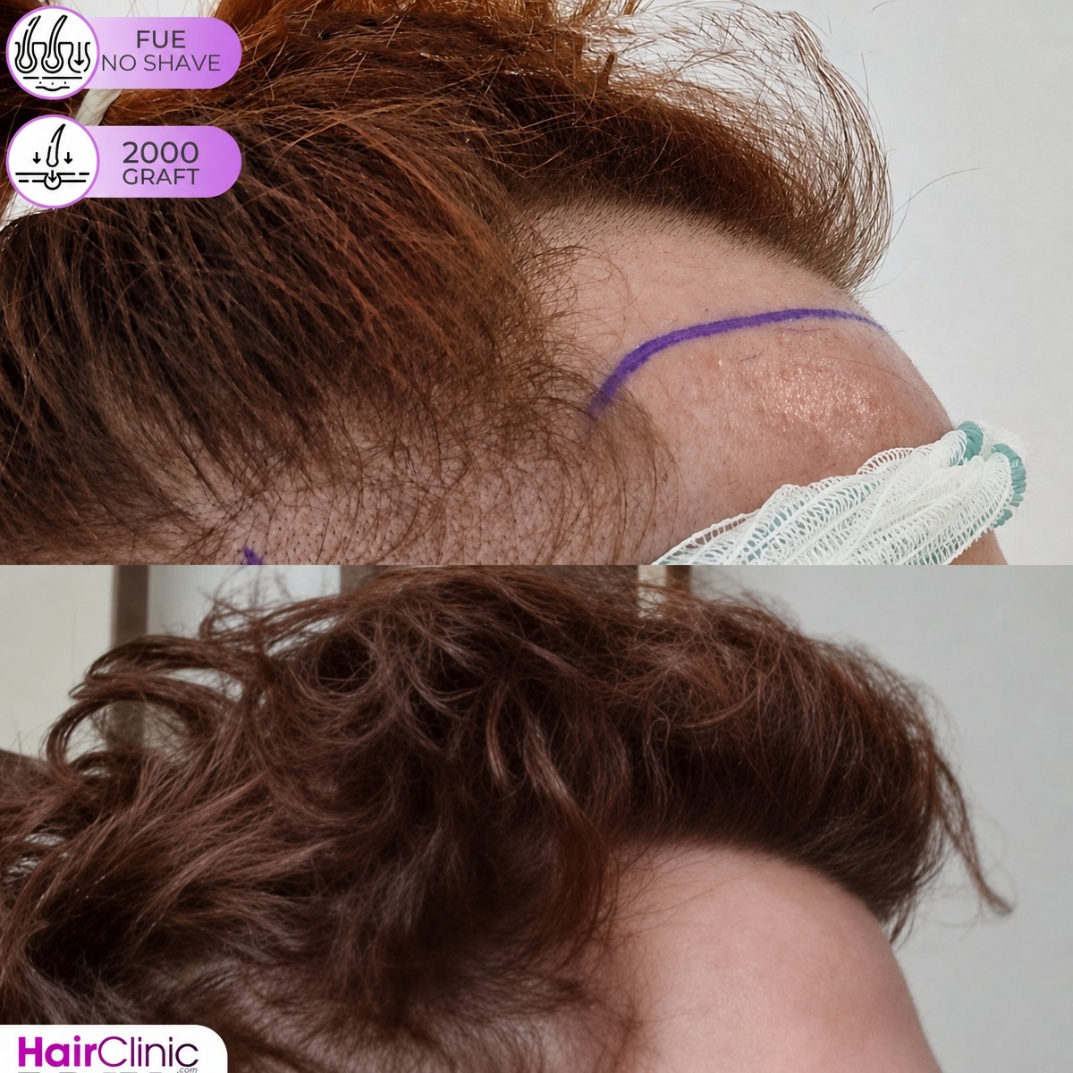 نتيجة زراعة الشعر FUE بدون حلاقة في Hair Clinic PRIVÉ، 2000 طعم قبل وبعد