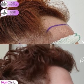 Before and after FUE no-shave hair transplant at Hair Clinic PRIVÉ, 2000 grafts result