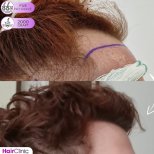 Before and after FUE no-shave hair transplant at Hair Clinic PRIVÉ, 2000 grafts result