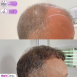 Before and after FUE Sapphire hair transplant at Hair Clinic PRIVÉ, 2500 grafts result