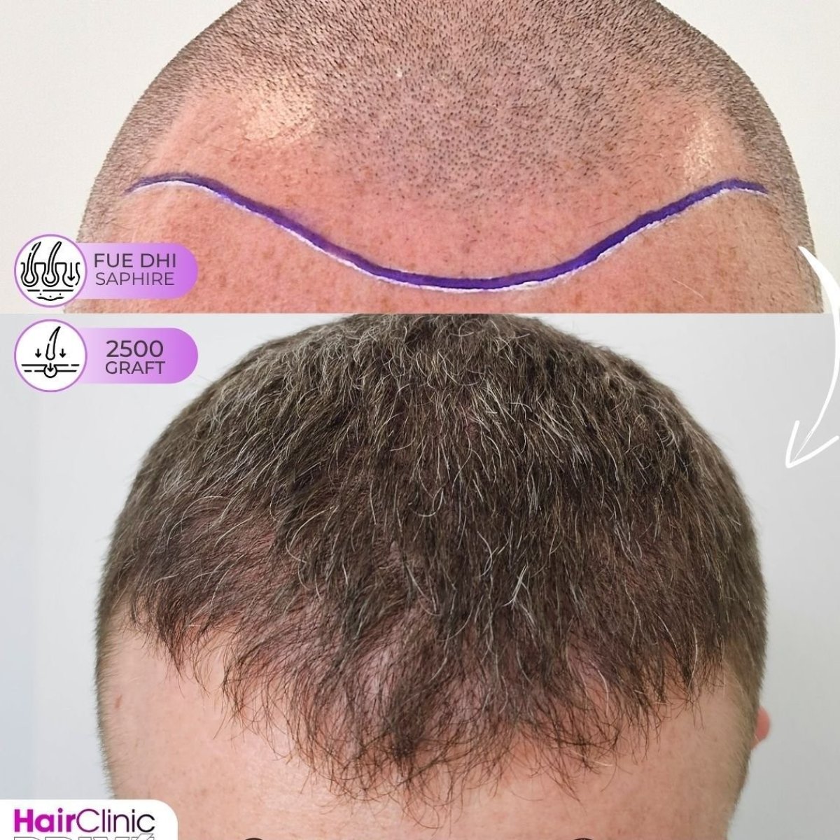 Antes y después de trasplante capilar FUE en Hair Clinic PRIVÉ, 2500 injertos resultado natural