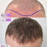 Before and after FUE hair transplant at Hair Clinic PRIVÉ, 2500 grafts natural result