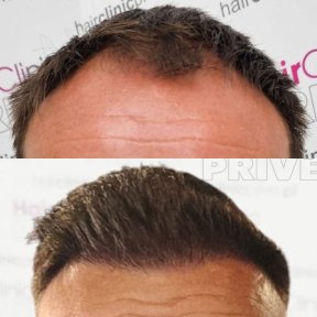 Before and after DHI hair transplant result at Hair Clinic PRIVÉ, restored hairline in male patient