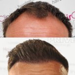 Before and after DHI hair transplant result at Hair Clinic PRIVÉ, restored hairline in male patient