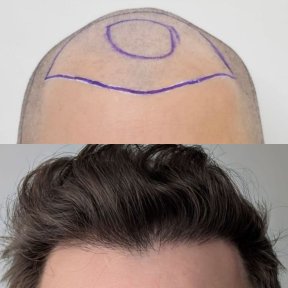 Before and after DHI hair transplant result at Hair Clinic PRIVÉ, restored natural hairline