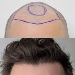 Before and after DHI hair transplant result at Hair Clinic PRIVÉ, restored natural hairline