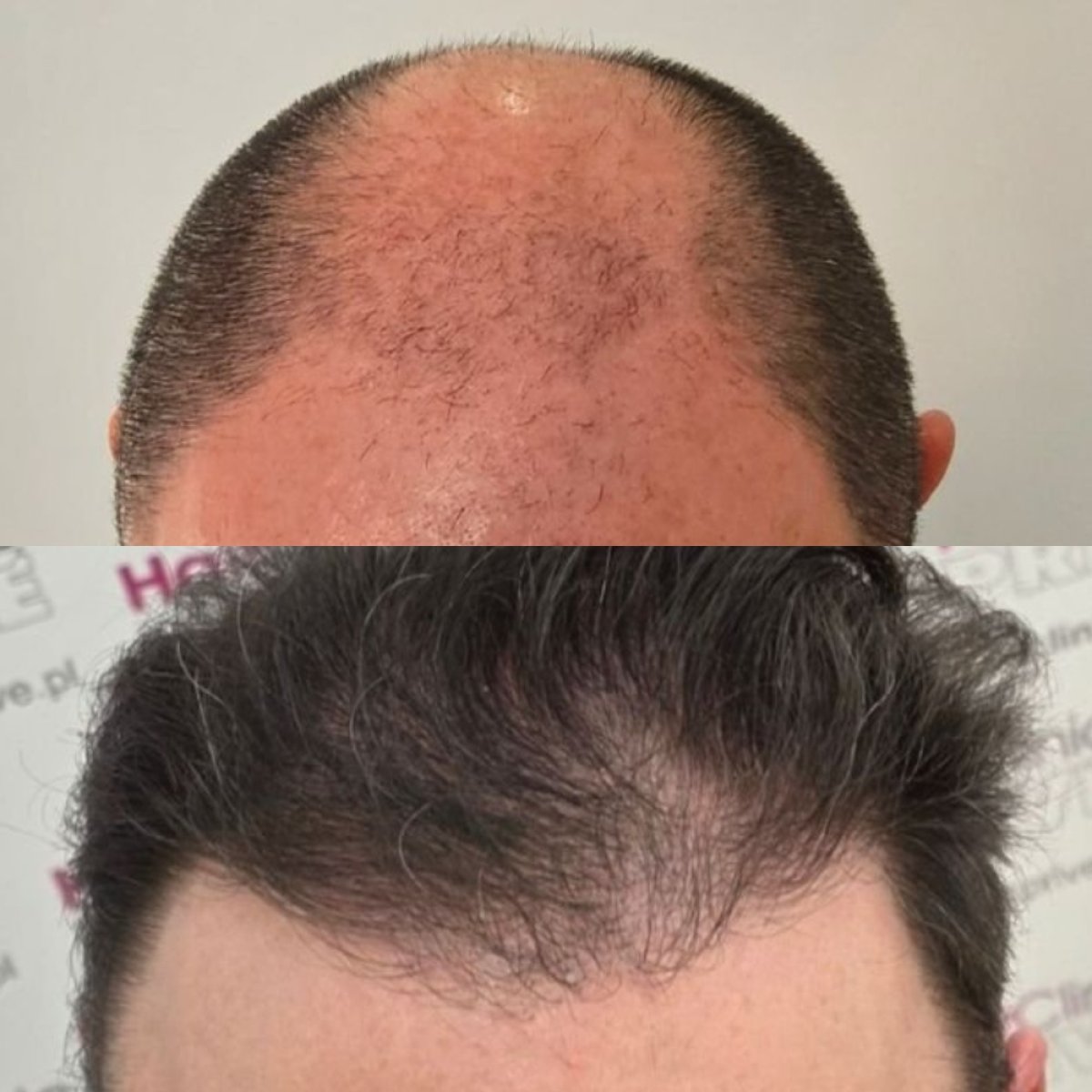 Resultado antes y después de trasplante capilar DHI en Hair Clinic PRIVÉ – línea restaurada
