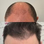 Before and after DHI hair transplant result at Hair Clinic PRIVÉ – restored hairline in male patient