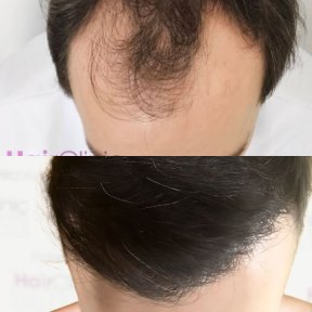 Before and after DHI hair transplant result at Hair Clinic PRIVÉ, restored hairline in male patient