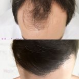 Before and after DHI hair transplant result at Hair Clinic PRIVÉ, restored hairline in male patient