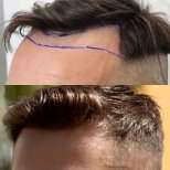Before and after DHI hair transplant result at Hair Clinic PRIVÉ, restored natural hairline