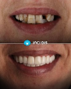 before-after photo implantacia-zuba