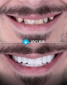 before-after photo implantacia-zuba