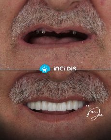 before-after photo implantacia-zuba