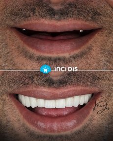 before-after photo implantacia-zuba