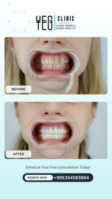 before-after photo tooth-extraction