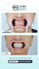 before-after photo tooth-extraction