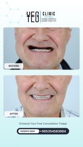 before-after photo tooth-extraction